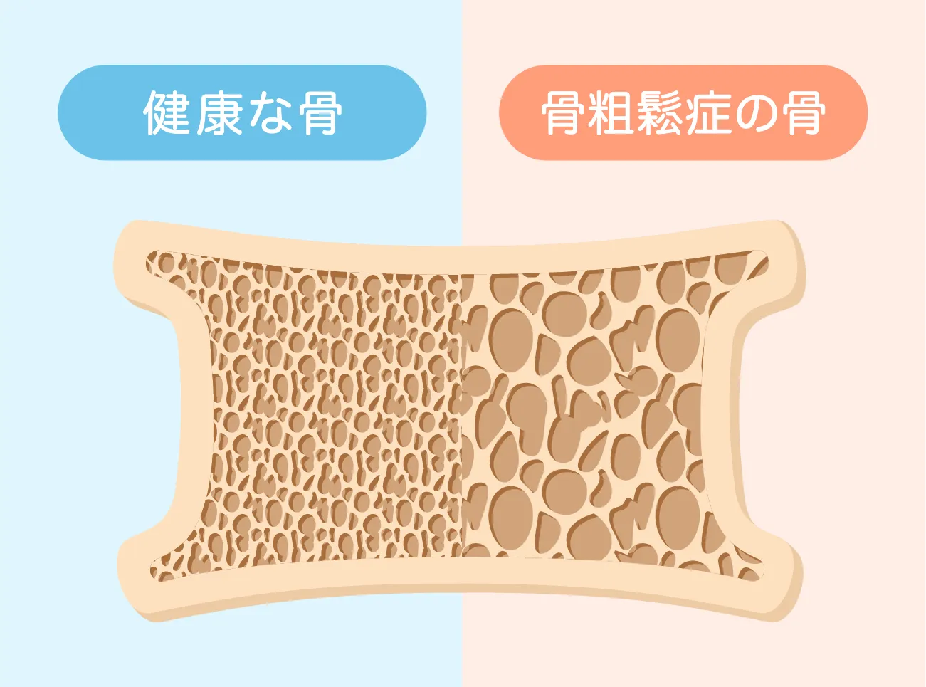 骨粗しょう症